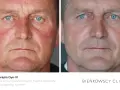 Przed i po fototerapii Dye-VI: widoczna poprawa rumienia i zmian naczyniowych, skuteczna w leczeniu trądziku różowatego u mężczyzn.
