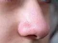 Widok z bliska na nos z widocznymi porami. Czy **isopropyl palmitate** jest szkodliwy dla skóry?