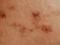 Skóra z zaczerwienionymi, nierównymi zmianami, przypominającymi pokrzywkę alergiczną.