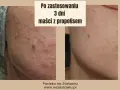 Przed i po zastosowaniu maści z propolisem: skóra z niedoskonałościami po 3 dniach kuracji wygląda znacznie lepiej.
