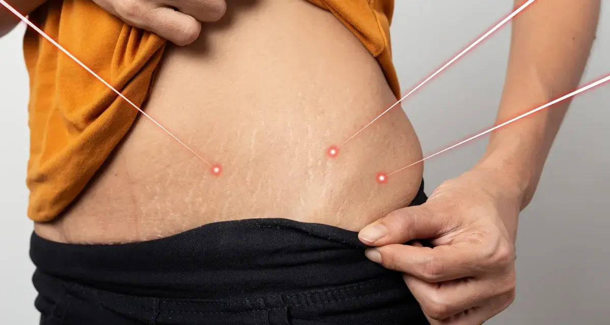 Skóra z widocznymi rozstępami, na którą skierowane są czerwone linie laserowe. Rozważ retinol na rozstępy dla poprawy wyglądu.
