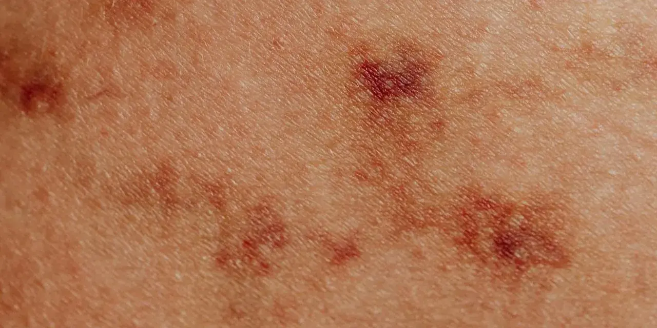 Skóra z zaczerwienionymi, nierównymi zmianami, przypominającymi pokrzywkę alergiczną.