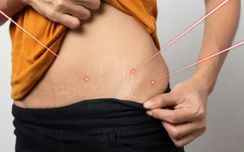 Skóra z widocznymi rozstępami, na którą skierowane są czerwone linie laserowe. Rozważ retinol na rozstępy dla poprawy wyglądu.