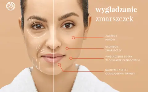 Kobieta z widocznymi zmarszczkami na policzkach po jednej stronie, a po drugiej gładka skóra. Zabieg wygładza zmarszczki.