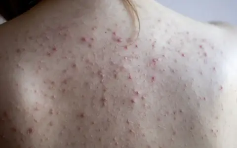 Widok z bliska na plecy z licznymi zmianami, które wskazują na trądzik na plecach.