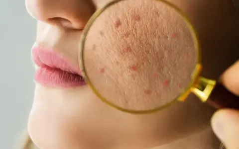 Powiększony fragment skóry z widocznymi czerwonymi krostkami, sugerującymi problem z fungal acne.