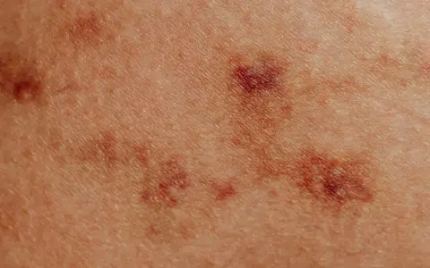 Skóra z zaczerwienionymi, nierównymi zmianami, przypominającymi pokrzywkę alergiczną.