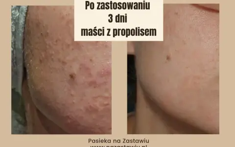Przed i po zastosowaniu maści z propolisem: skóra z niedoskonałościami po 3 dniach kuracji wygląda znacznie lepiej.