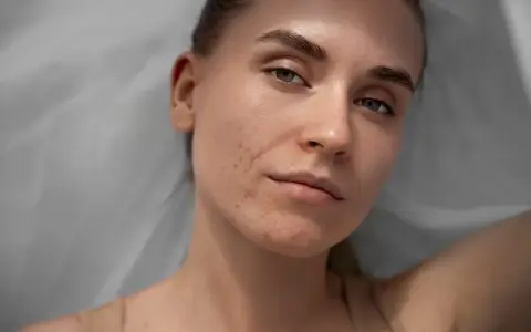 Młoda kobieta z widocznymi przebarwieniami hormonalnymi na twarzy, w tym trądzikiem i zaczerwienieniami.