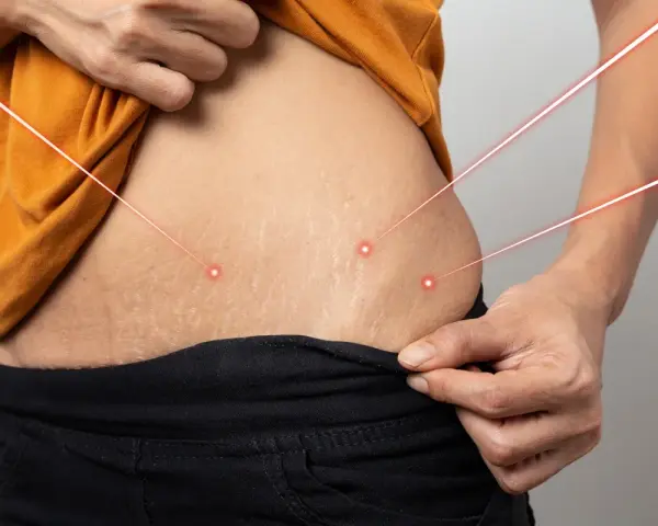 Skóra z widocznymi rozstępami, na którą skierowane są czerwone linie laserowe. Rozważ retinol na rozstępy dla poprawy wyglądu.