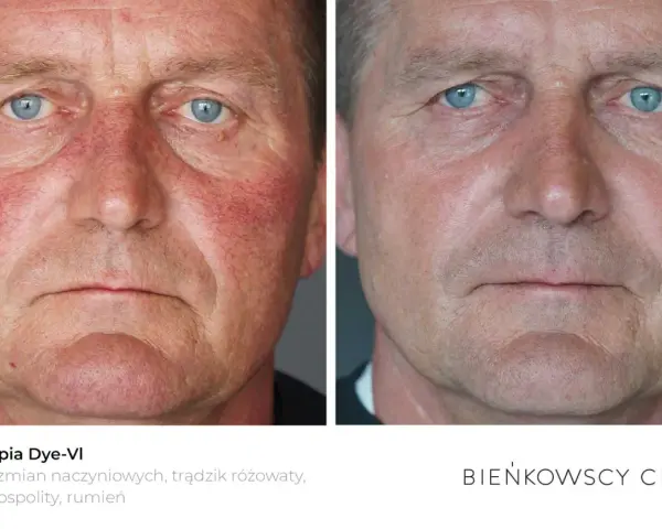 Przed i po fototerapii Dye-VI: widoczna poprawa rumienia i zmian naczyniowych, skuteczna w leczeniu trądziku różowatego u mężczyzn.