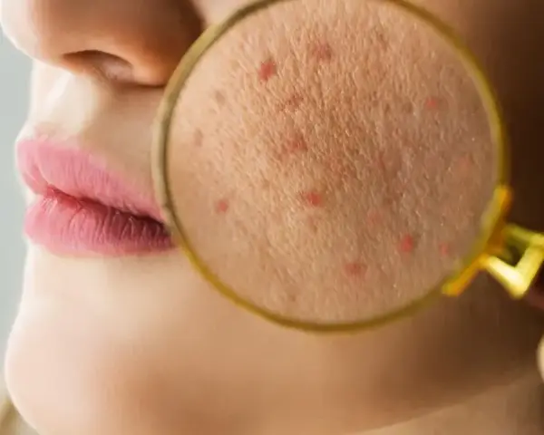 Powiększony fragment skóry z widocznymi czerwonymi krostkami, sugerującymi problem z fungal acne.