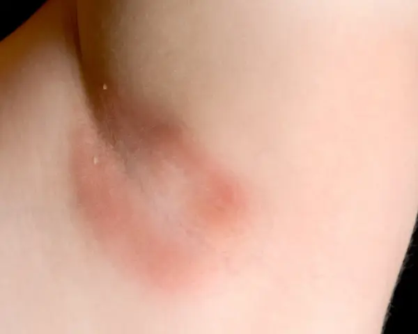Czerwone plamy pod pachami, zaczerwienienie skóry w okolicy pachy, możliwe podrażnienie.