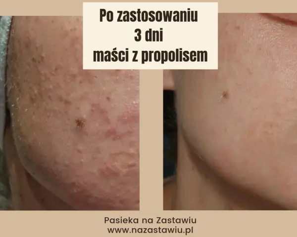Przed i po zastosowaniu maści z propolisem: skóra z niedoskonałościami po 3 dniach kuracji wygląda znacznie lepiej.
