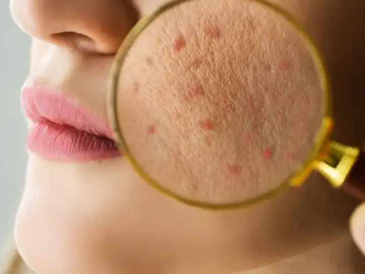 Powiększony fragment skóry z widocznymi czerwonymi krostkami, sugerującymi problem z fungal acne.