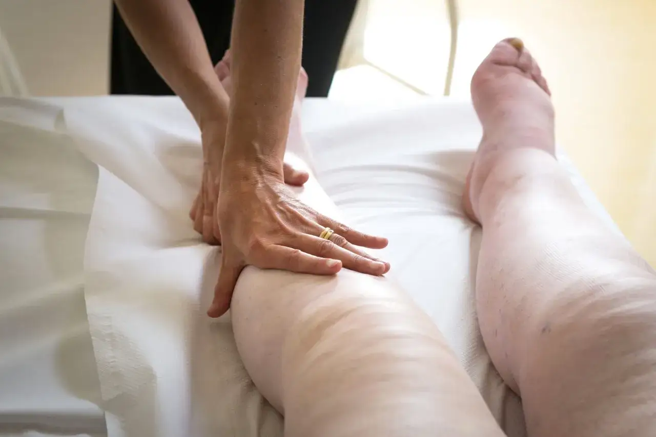 Dłoń terapeuty masuje nogę z widocznym obrzękiem limfatycznym.