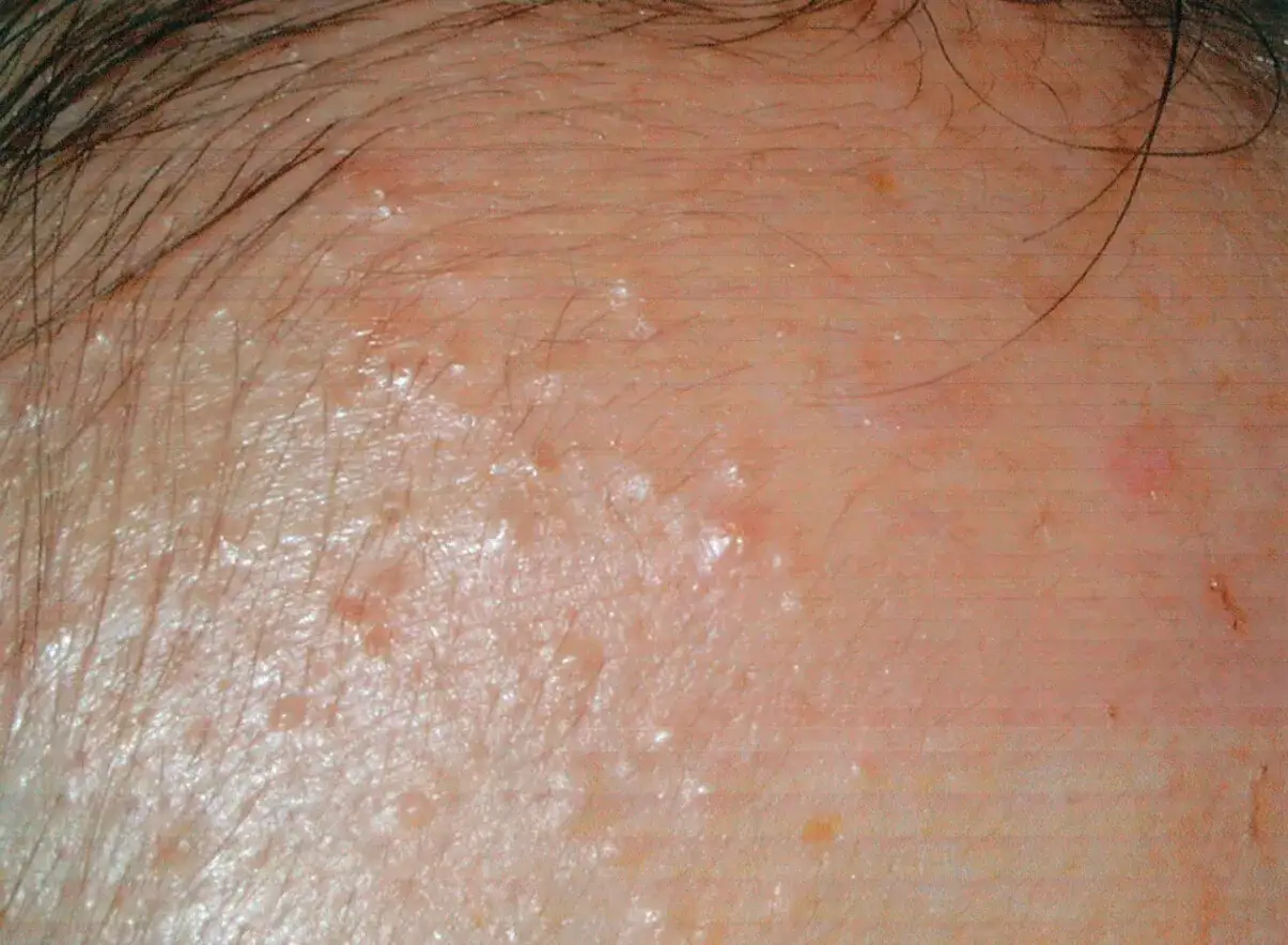 Skóra czoła z licznymi drobnymi krostkami i zaczerwienieniami, sugerującymi fungal acne. Włosy na linii czoła.