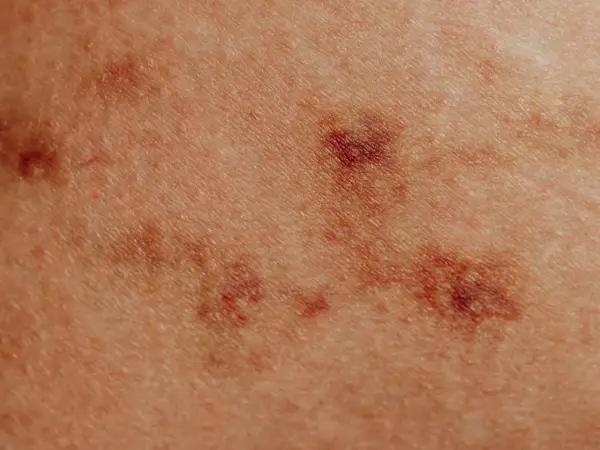 Skóra z zaczerwienionymi, nierównymi zmianami, przypominającymi pokrzywkę alergiczną.